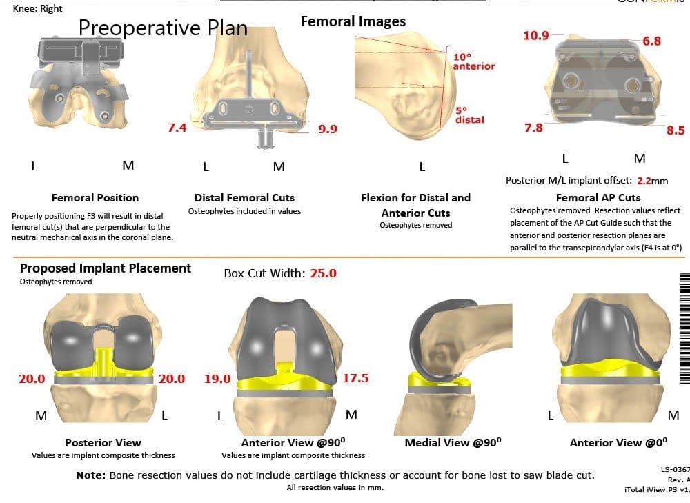 Plan quirúrgico completo específico para pacientes en ortopedia para un reemplazo personalizado de rodilla derecha en una mujer de 65 años - escaneo 2