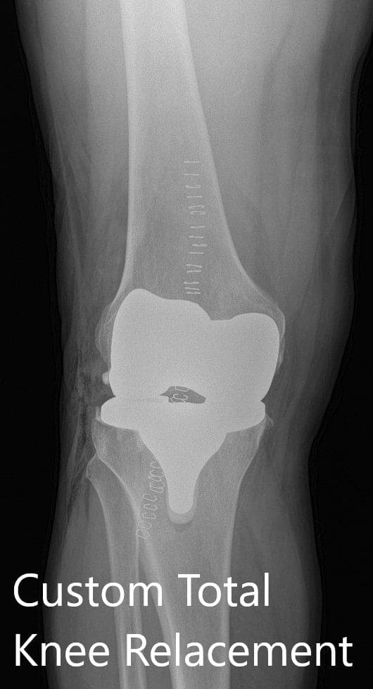 Radiografía postoperatoria que muestra la AP y las vistas laterales de la rodilla derecha