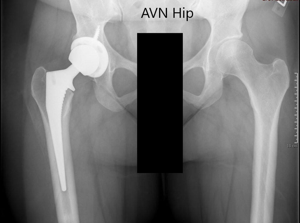 Radiografía preoperatoria de la pelvis con ambas caderas mostrando articulación artificial intacta en el lado derecho y AVN en la cadera izquierda