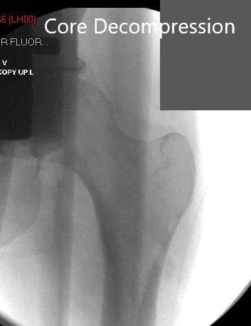 Imagen postoperatoria tras la descompresión del núcleo y la inyección de la extracción de células madre