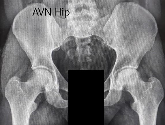 Radiografía preoperatoria de la pelvis con ambas caderas en vista anteroposterior que muestra el AVN de la cadera izquierda