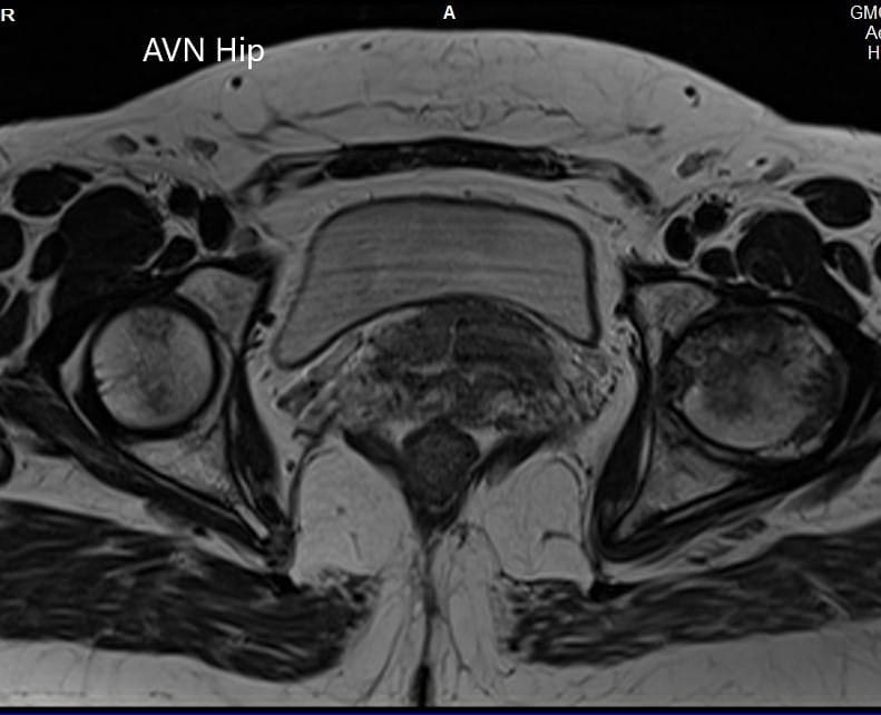 T1WI de la resonancia magnética que muestra una sección axial de la cabeza femoral bilateral