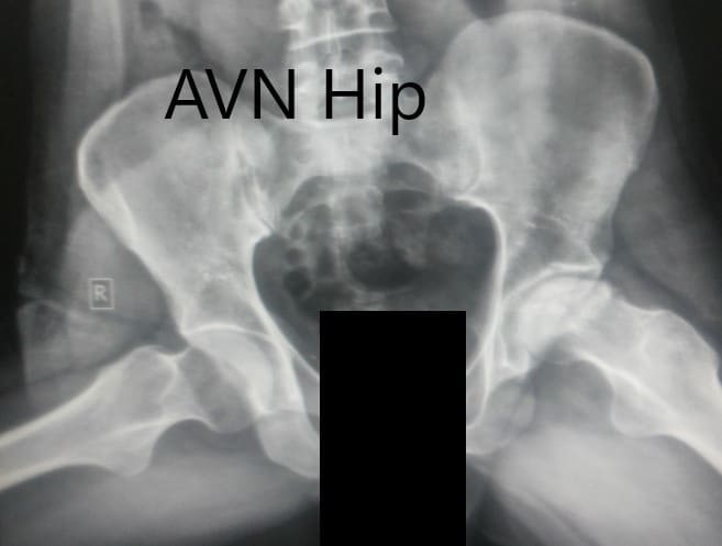 Frog-legged lateral view of both the hip joints