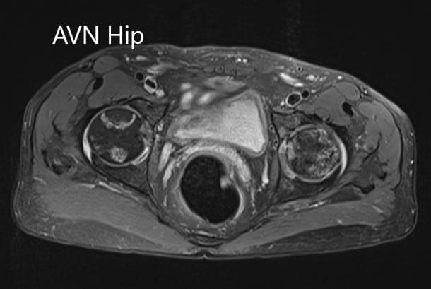 Axial sections of and T2WI