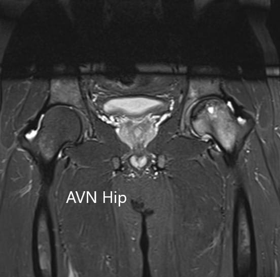 Sección coronal T2WI de la resonancia magnética que muestra AVN de cadera