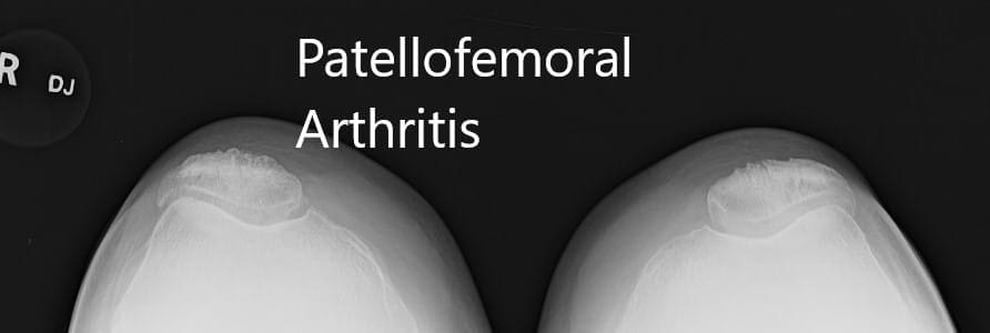 Radiografía preoperatoria que muestra la visión AP y lateral de la articulación de la rodilla derecha, y vista del horizonte de ambas articulaciones - IMG 3 Radiografía preoperatoria que muestra la visión AP y lateral de la articulación de la rodilla derecha, y vista del horizonte de ambas articulaciones - IMG 3