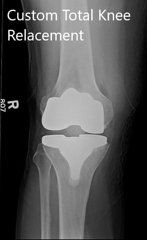 Radiografía postoperatoria que muestra imágenes AP e laterales de la rodilla derecha Radiografía postoperatoria que muestra imágenes AP e laterales de la rodilla derecha