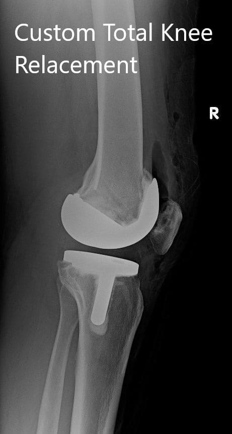 Radiografía postoperatoria que muestra imágenes AP e laterales de la rodilla derecha - IMG 2 Radiografía postoperatoria que muestra imágenes AP e laterales de la rodilla derecha - IMG 2