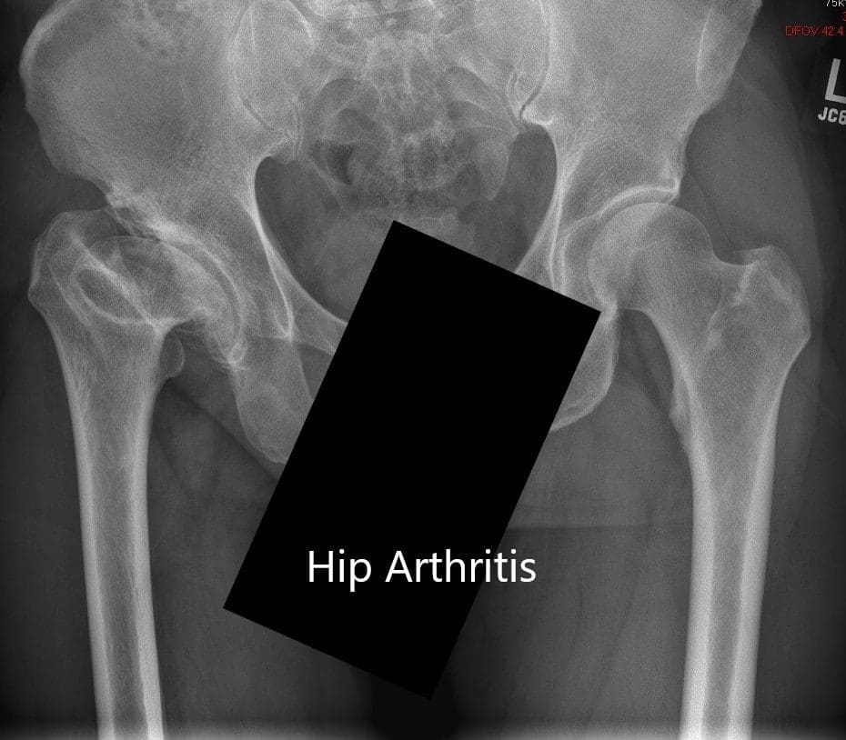 Preoperative X-ray showing the AP view of the pelvis with both hip joints