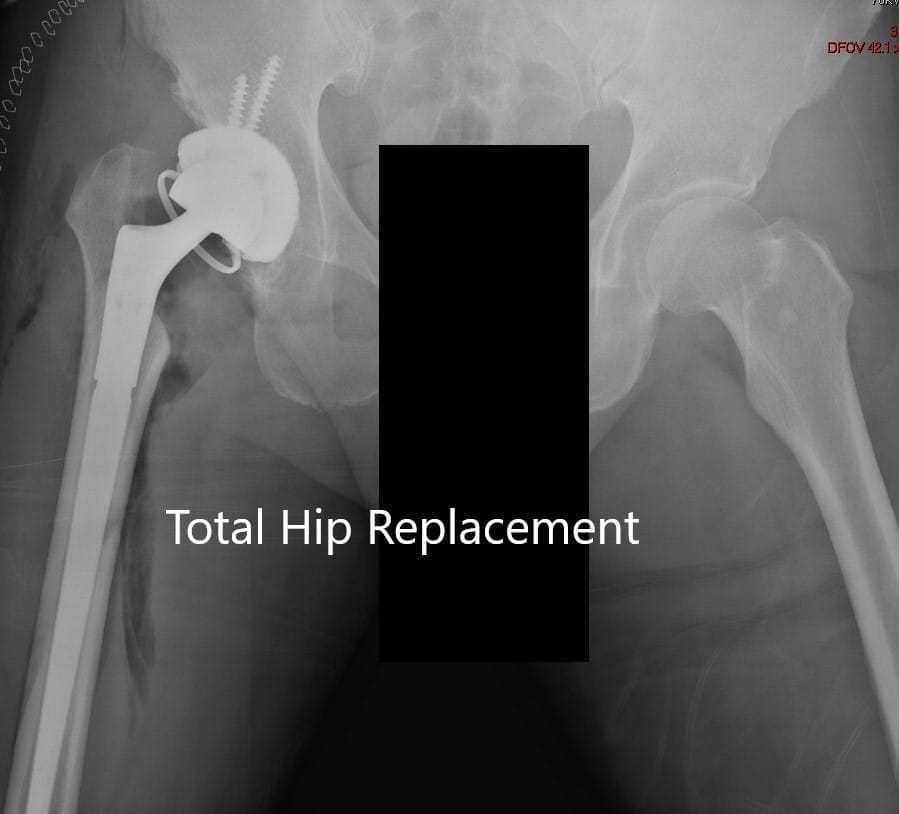 Postoperative X-ray showing AP view of the pelvis