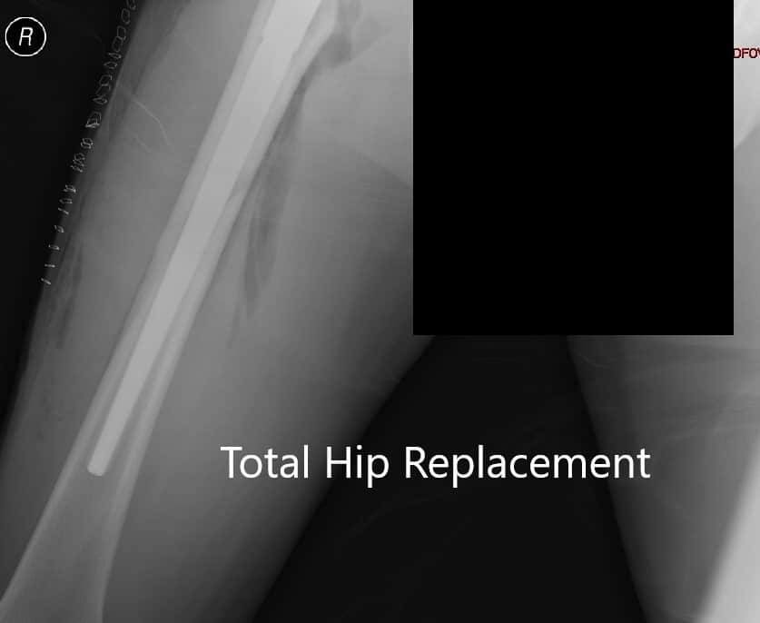 Postoperative X-ray showing AP view of the pelvis - img 2