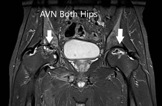 La resonancia magnética muestra un AVN bilateral femoral en T2WI
