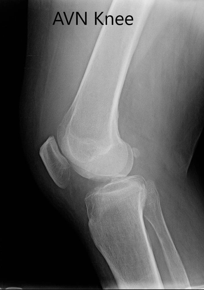 Radiografía preoperatoria de la rodilla derecha en vistas anteroposterior y lateral - img 2
