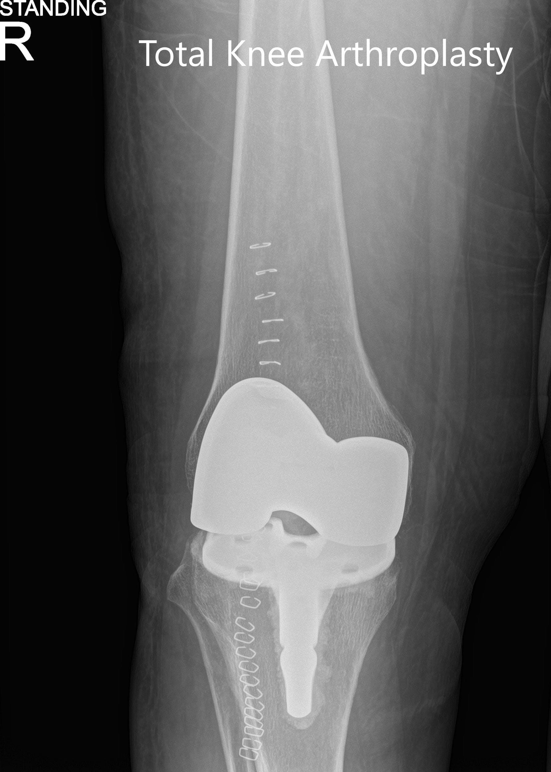 Radiografía postoperatoria que muestra las vistas anteroposterior y lateral de la rodilla derecha