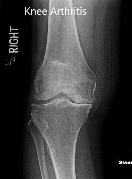 Radiografía preoperatoria que muestra la vista anteroposterior y lateral de la rodilla derecha. Radiografía preoperatoria que muestra la vista anteroposterior y lateral de la rodilla derecha Radiografía preoperatoria que muestra la vista anteroposterior y lateral de la rodilla derecha. Radiografía preoperatoria que muestra la vista anteroposterior y lateral de la rodilla derecha
