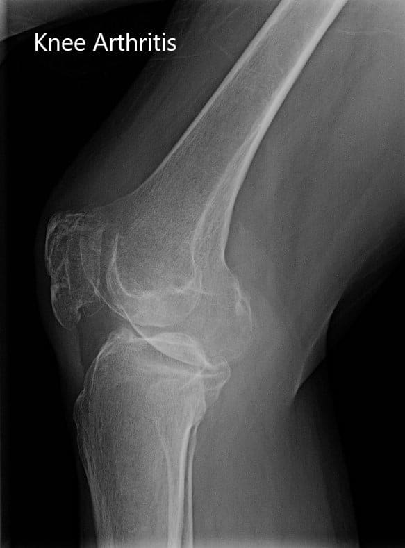 Radiografía preoperatoria que muestra la vista anteroposterior y lateral de la rodilla derecha. Radiografía preoperatoria que muestra la vista anteroposterior y lateral de la rodilla derecha - img 2 Radiografía preoperatoria que muestra la vista anteroposterior y lateral de la rodilla derecha. Radiografía preoperatoria que muestra la vista anteroposterior y lateral de la rodilla derecha - img 2