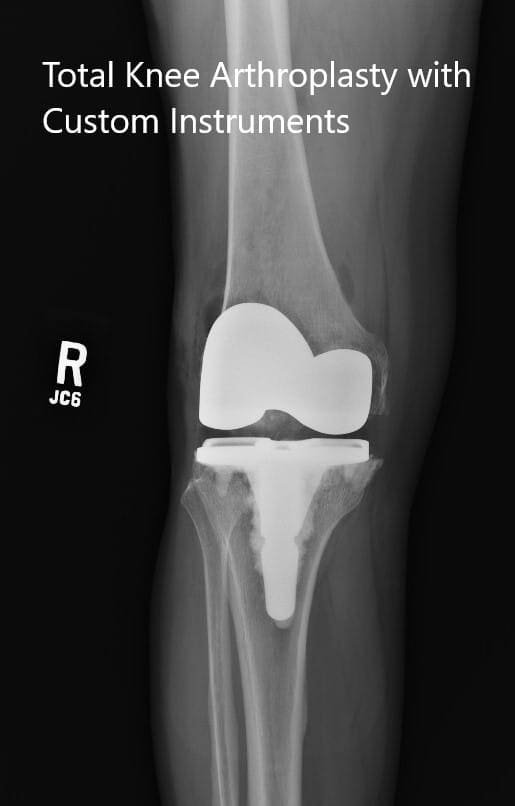 Radiografías postoperatorias que muestran las vistas anteroposterior y lateral de la rodilla derecha Radiografías postoperatorias que muestran las vistas anteroposterior y lateral de la rodilla derecha