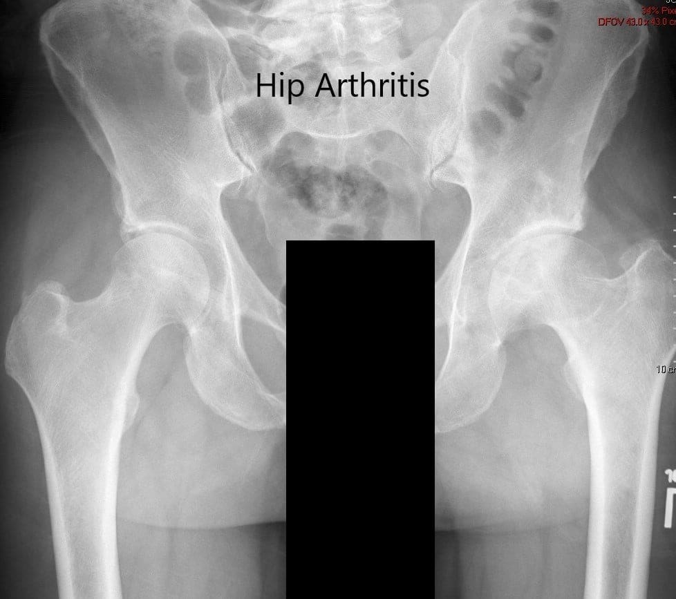 Radiografía preoperatoria de la pelvis que muestra vista AP de la pelvis con ambas caderas