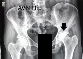 Radiografía preoperatoria de la pelvis con ambas caderas en vista anteroposterior