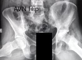 Radiografía preoperatoria de la pelvis con ambas caderas en vistas laterales con patas de rana