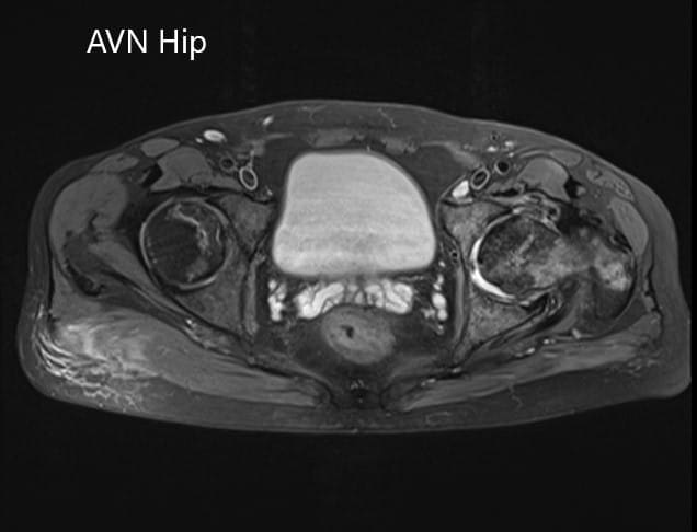 Sección axial del T2WI de la pelvis