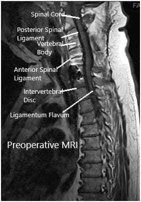Resonancia preoperatoria en la sección sagital