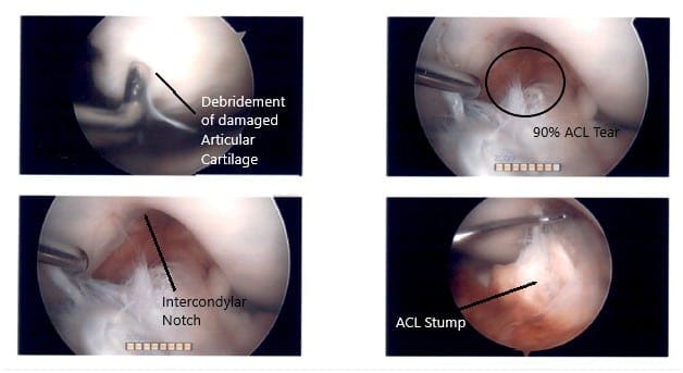 Intraoperative Arthroscopic Images of the left knee Intraoperative Arthroscopic Images of the left knee