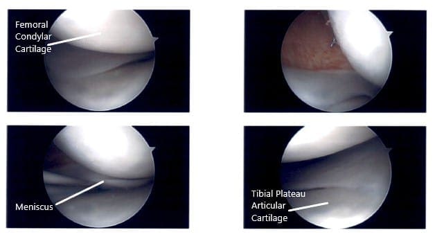 Intraoperative Arthroscopic Images of the left knee 2 Intraoperative Arthroscopic Images of the left knee 2