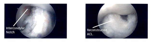 Intraoperative Arthroscopic Images of the left knee 3 Intraoperative Arthroscopic Images of the left knee 3