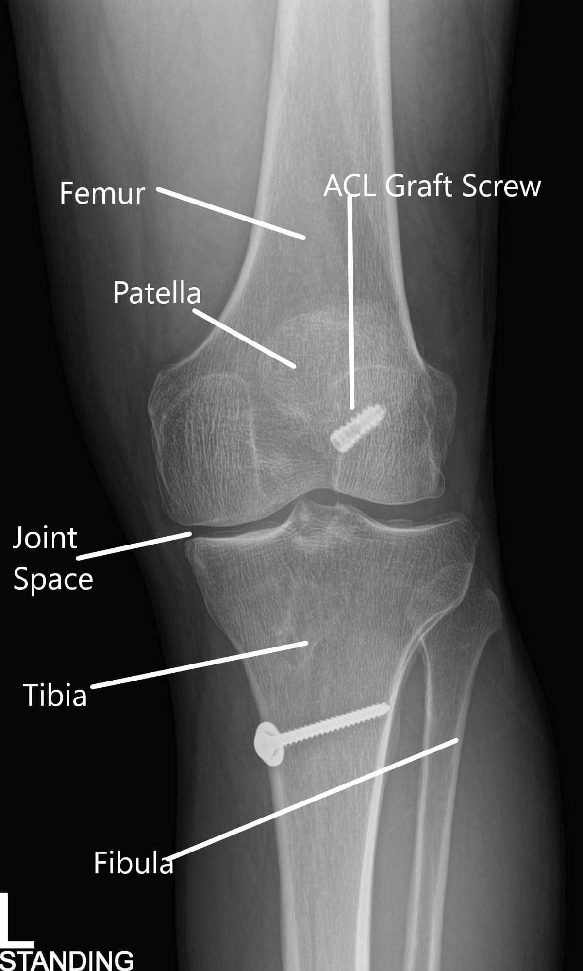 Radiografía de la rodilla izquierda en vistas AP y laterales