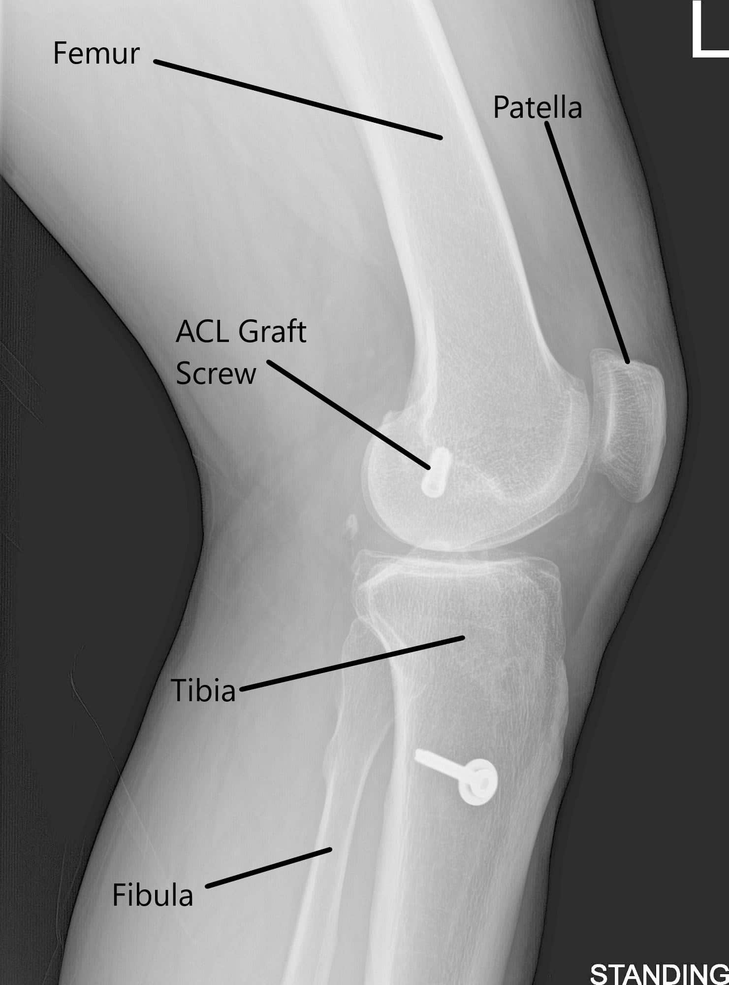 Radiografía de la rodilla izquierda en vistas AP y laterales