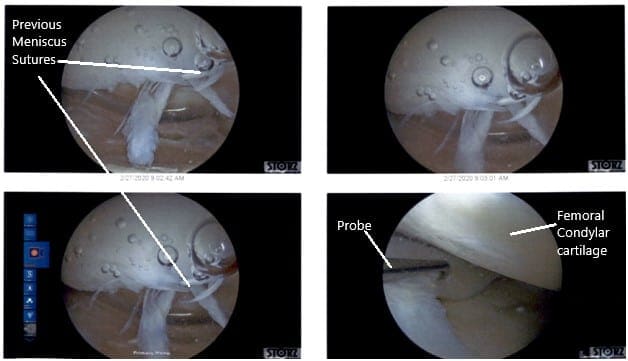 Vistas artroscópicas intraoperatorias de la rodilla izquierda