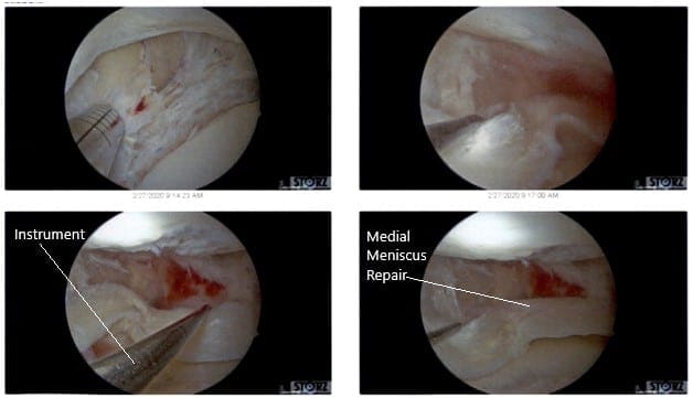 Vistas artroscópicas intraoperatorias de la rodilla izquierda 3