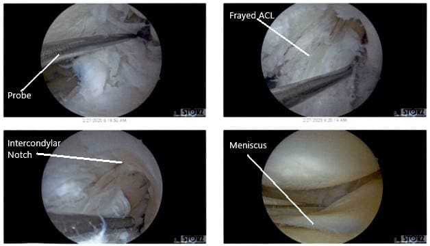 Vistas artroscópicas intraoperatorias de la rodilla izquierda 4