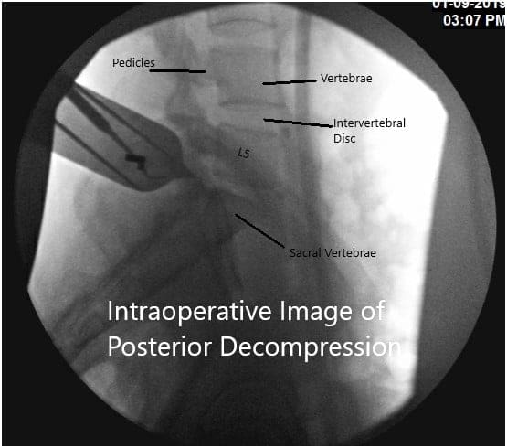 Imagen fluoroscópica intraoperatoria Imagen fluoroscópica intraoperatoria