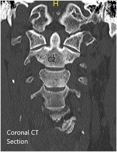 Preoperative Coronal and Axial CT sections Preoperative Coronal and Axial CT sections