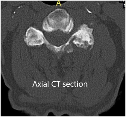 Preoperative Coronal and Axial CT sections 2 Preoperative Coronal and Axial CT sections 2