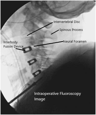 Intraoperative fluoroscopic images Intraoperative fluoroscopic images