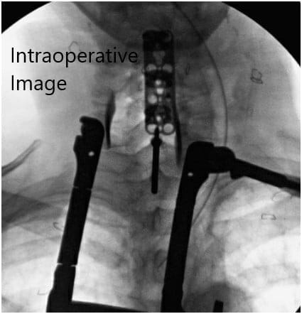 Intraoperative fluoroscopic images 3 Intraoperative fluoroscopic images 3