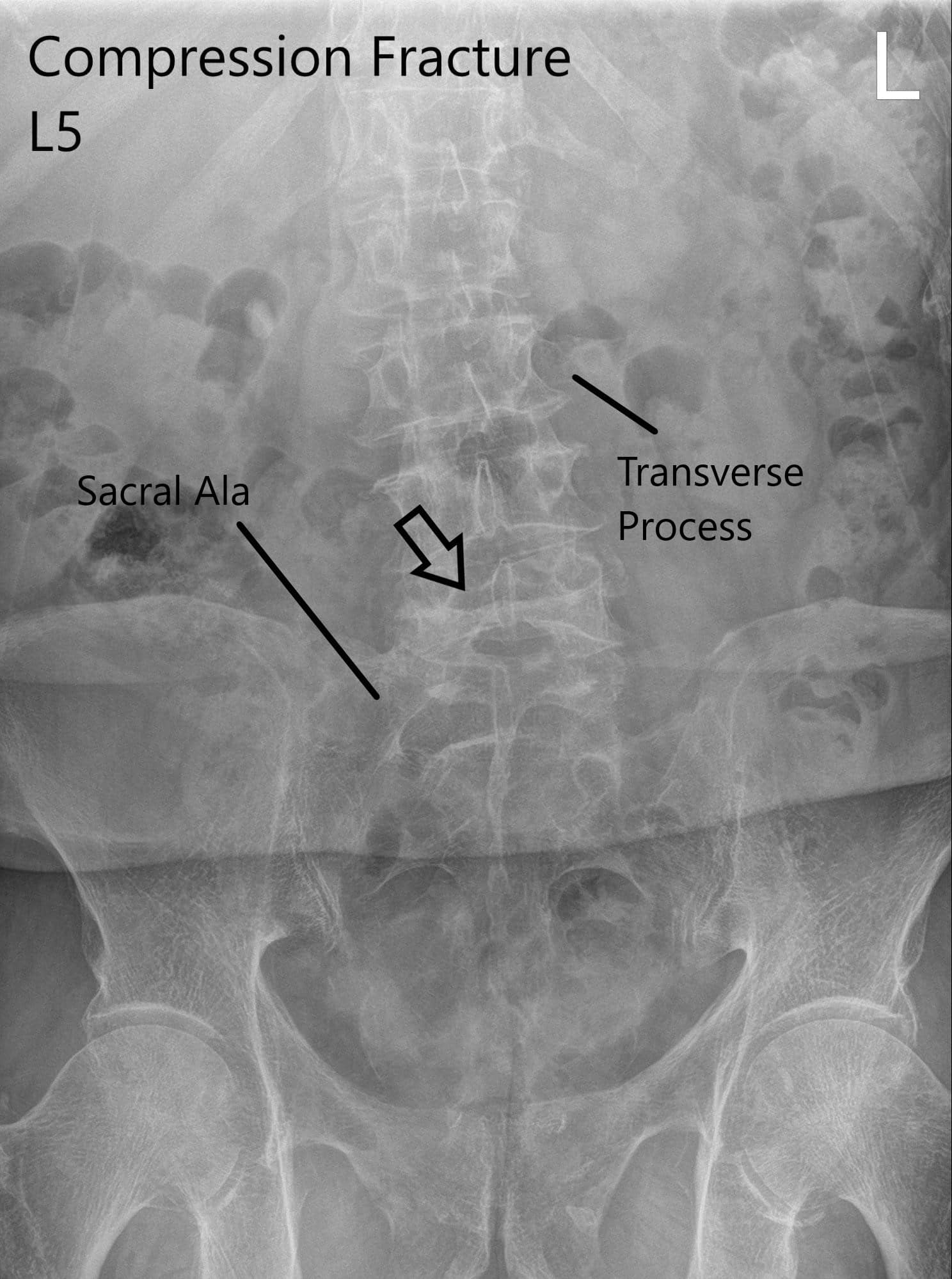 Radiografía de la columna LS en vistas AP y laterales que muestran fractura por compresión significativa en L5  