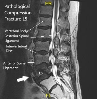 Resonancia magnética que muestra sección sagital de la columna lumbar sacra