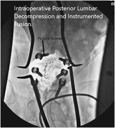 Imágenes de fluoroscopia intraoperatoria