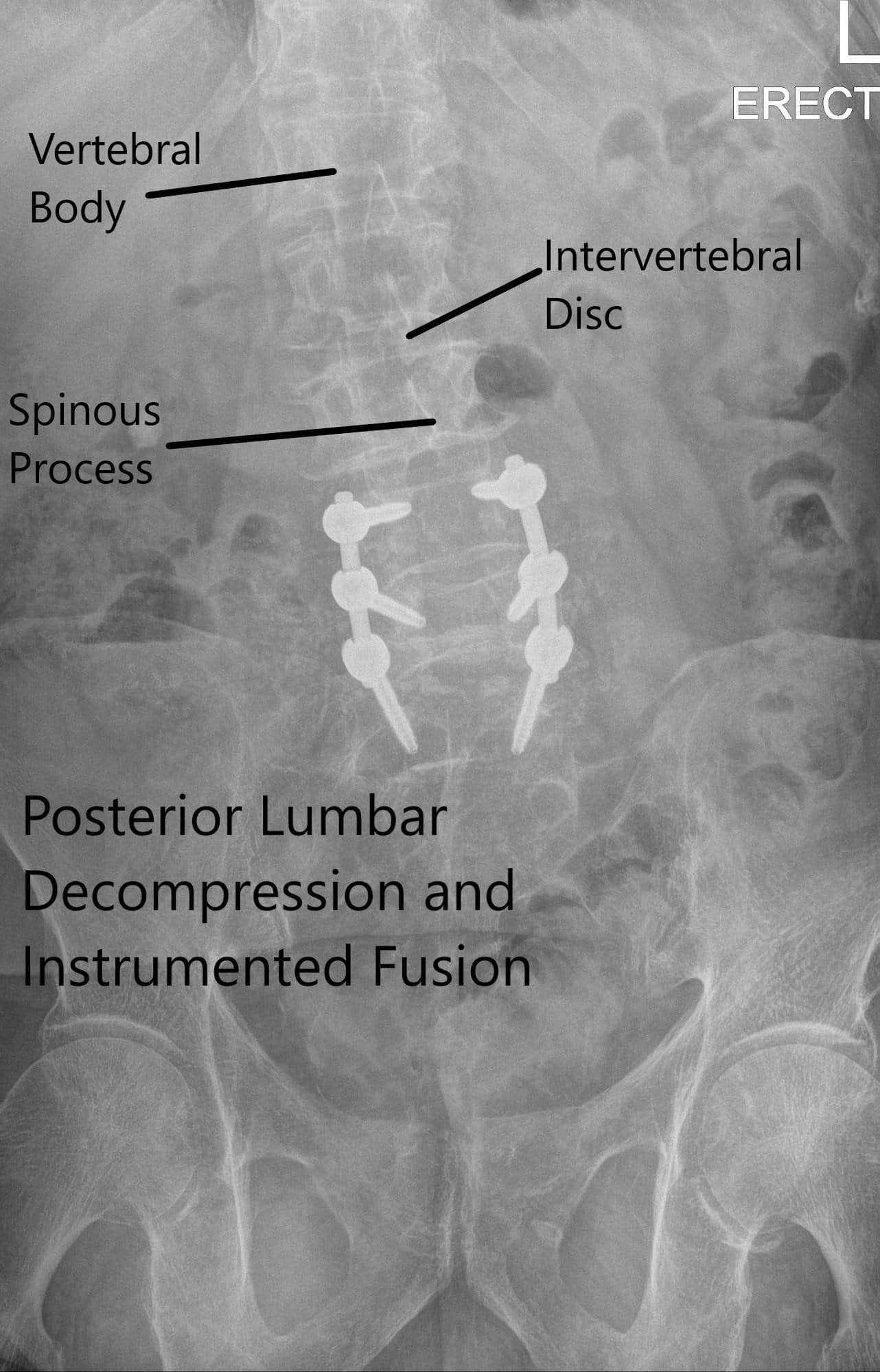 Radiografía postoperatoria que muestra la visión AP y lateral