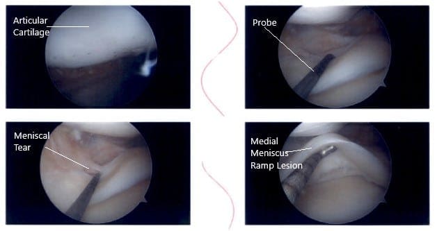 Imágenes artroscópicas intraoperatorias de rodilla