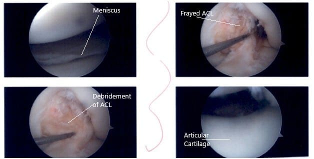 Imágenes artroscópicas intraoperatorias de rodilla 3