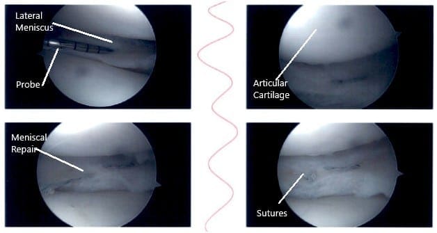 Imágenes artroscópicas intraoperatorias de rodilla 4