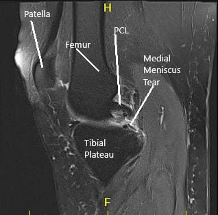 La resonancia magnética de la rodilla derecha sugirió desgarro del menisco medial y artritis patelofemoral de la rodilla derecha 3 La resonancia magnética de la rodilla derecha sugirió desgarro del menisco medial y artritis patelofemoral de la rodilla derecha 3