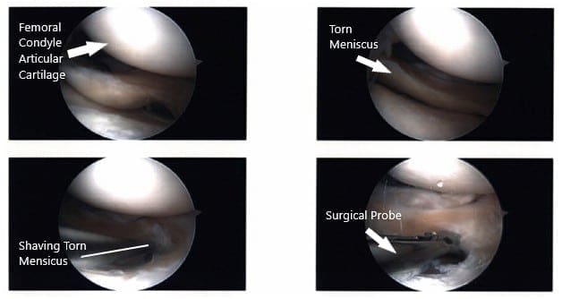 Imágenes artroscópicas intraoperatorias de la rodilla izquierda 2
