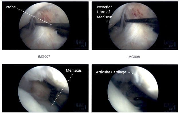 Intraoperative Arthroscopic Images of the right knee