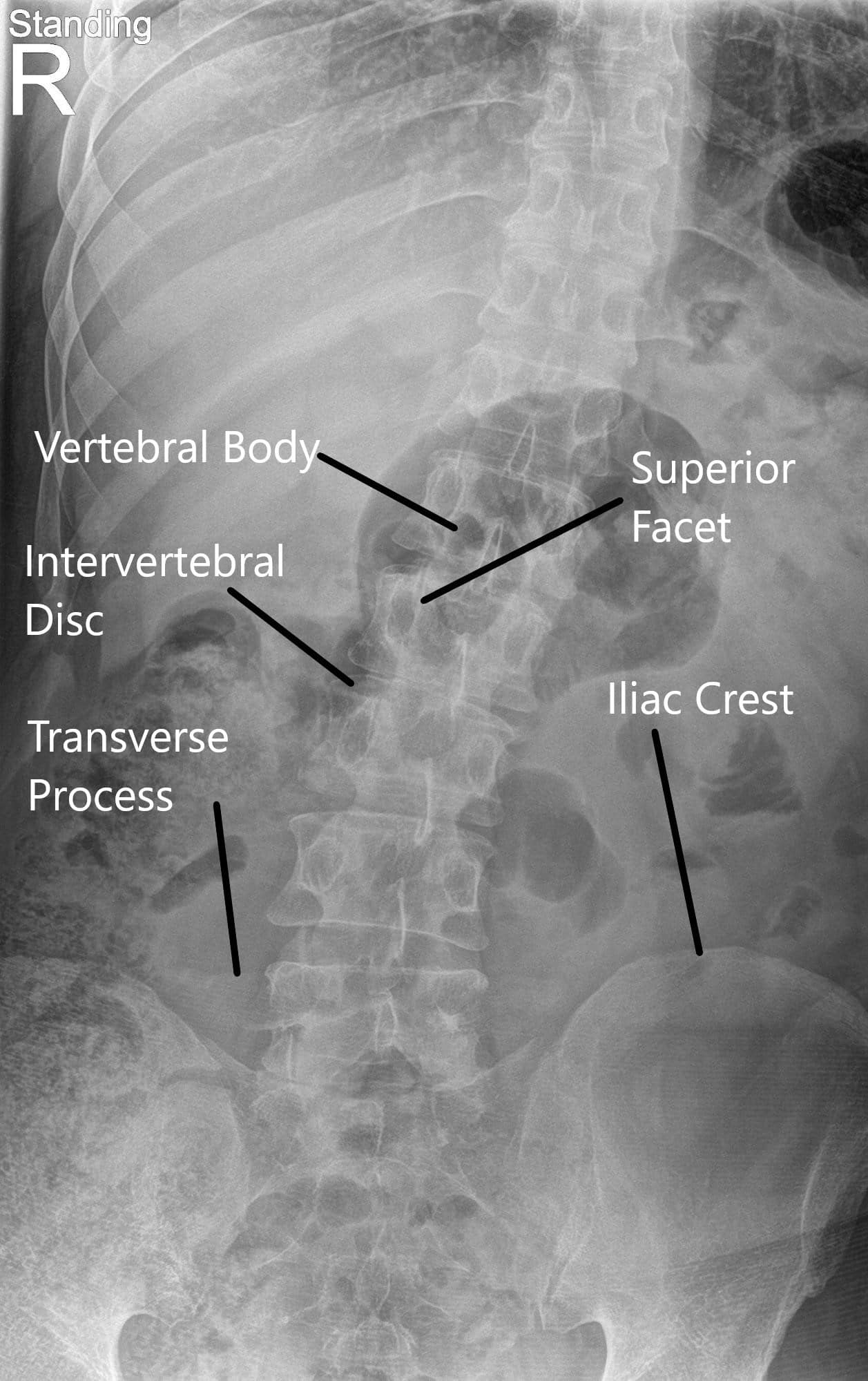 Radiografía de la columna vertebral en vistas AP y laterales